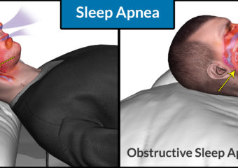 SLEEP APNEA TYPES