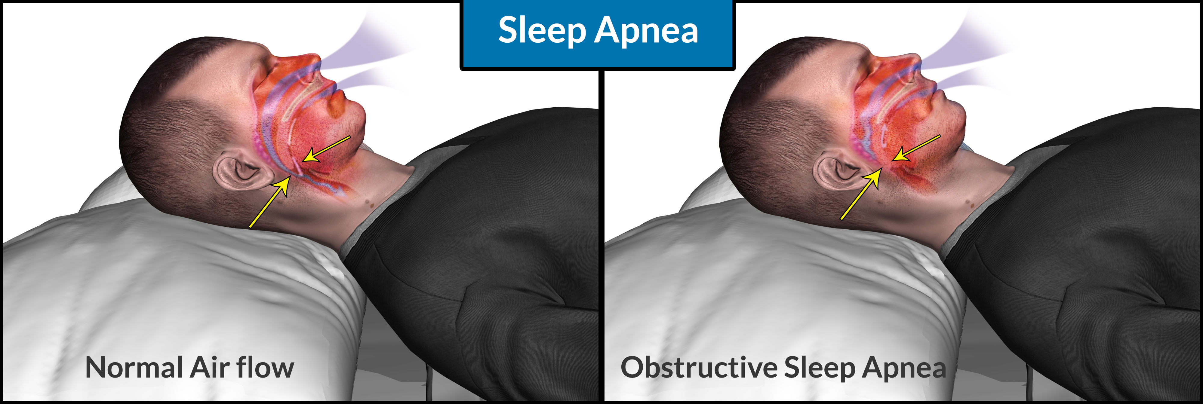 Obstructive Sleep Apnoea Treatment In Pune And Pcmc Mild Sleep Apnea Treatment In Pune And Pcmc